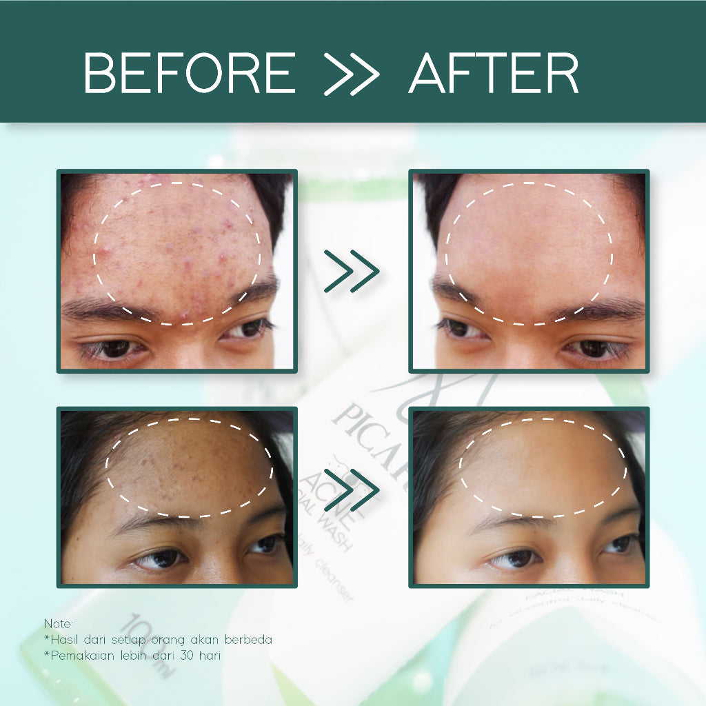 PICARE Acne & Oil Control Cream