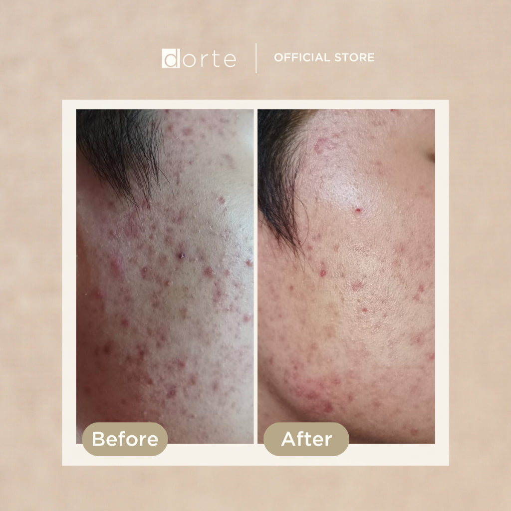 Dorte Succinic Acid Acne Moisturizer - Glow Mates Exclusive