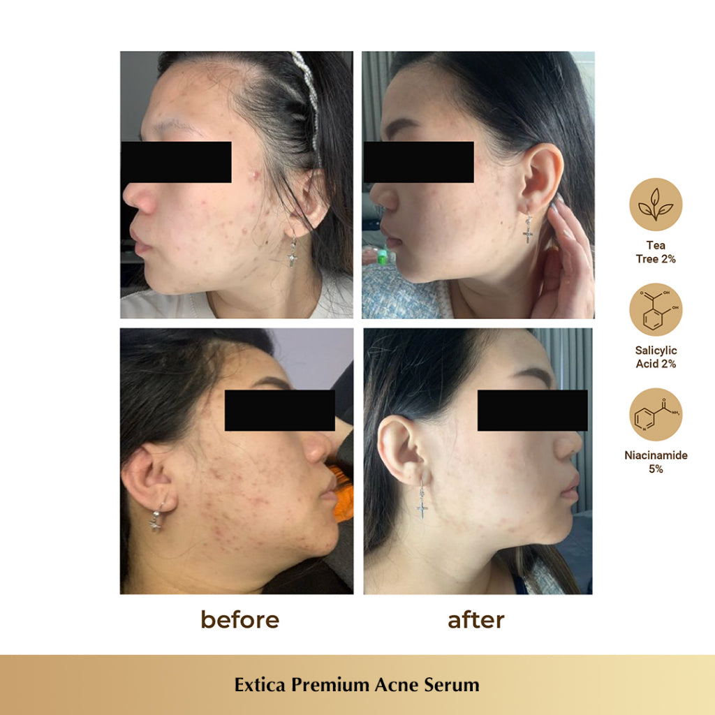 Extica Premium Acne Serum - Glow Mates Exclusive