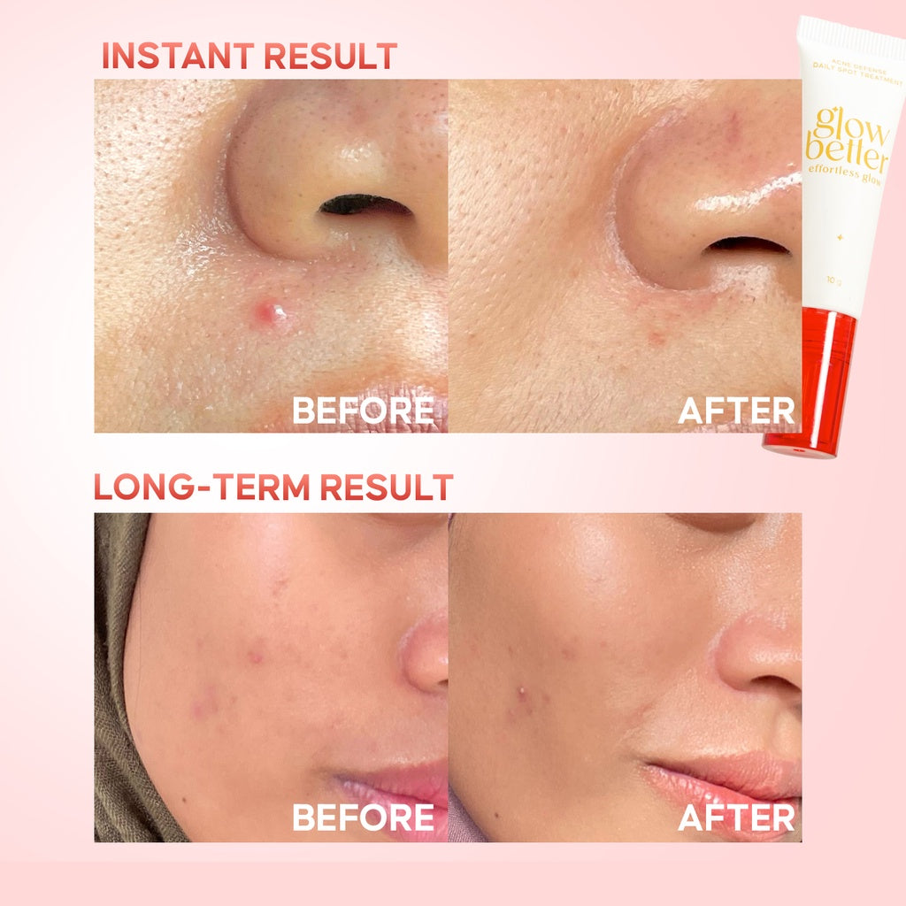 Glow Better Effortless Glow Acne Defense Daily Spot Treatment - Glow Mates Exclusive