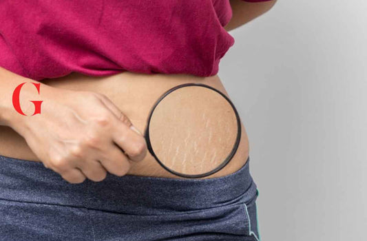7 Cara Menghilangkan Stretch Mark secara Alami
