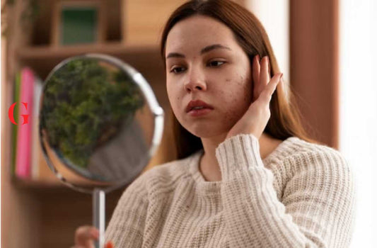 7 Cara Mengatasi Jerawat Mendem yang Efektif