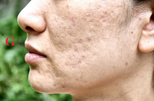 5 Kandungan Skincare untuk Atasi Wajah Bopeng Bekas Jerawat