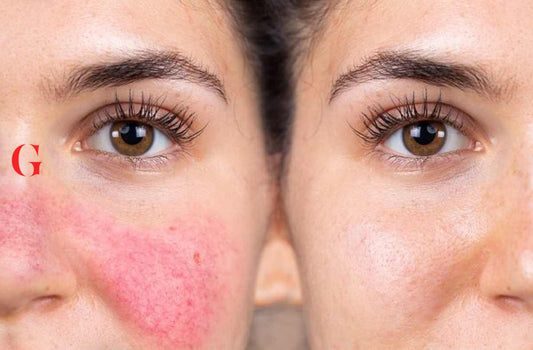 Wajah Perih Saat Pakai Skincare: Apa Penyebabnya?