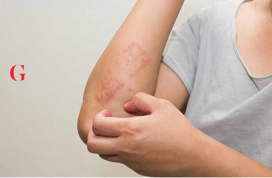6 Kandungan Skincare yang Bisa Digunakan untuk Si Pemilik Eksim