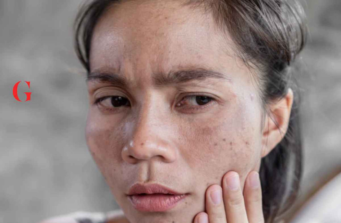 Polusi Bikin Wajah Gampang Jerawatan, Ini Skincare Saran Dokter Kulit