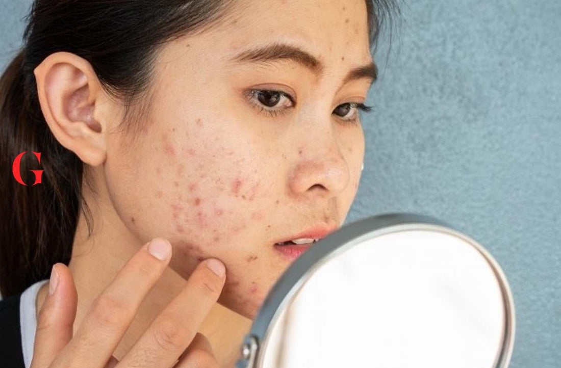 5 Bahan Aktif Skincare untuk Atasi Jerawat, Acne Fighter Wajib Tahu!