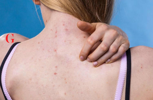 Rekomendasi Produk Body Care untuk Jerawat Punggung
