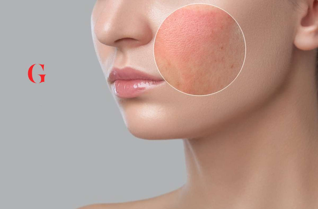 Produk Untuk Menghilangkan Kemerahan di Wajah: 8 Pilihan yang Aman untuk Kulit Sensitif dan Rosacea