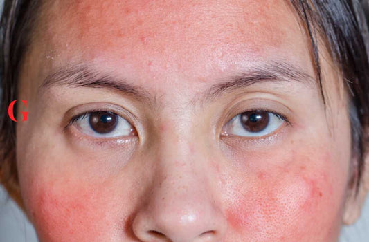 Kulit Terasa Perih Saat Mengaplikasikan Produk Skin Care? Bisa Jadi Ini Sebabnya!