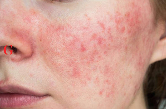 Skincare Menghilangkan Bekas Jerawat Merah di Pipi!