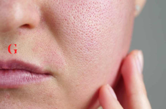 6 Kandungan Skincare untuk Mengecilkan Pori-Pori Wajah