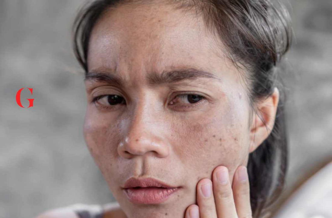 Alasan Mengapa Penggunaan Skincare Muka Bisa Menyebabkan Kulit Kusam dan Gelap