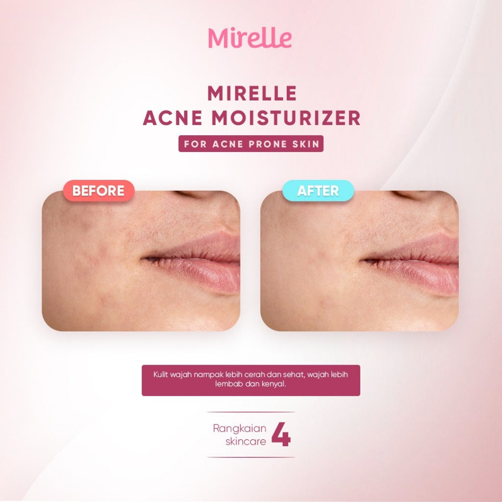 Mirelle Acne Moisturizer- Glow Mates Exclusive (350 POIN)